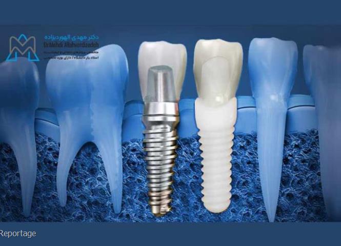 خدمات ایمپلنت دندانی