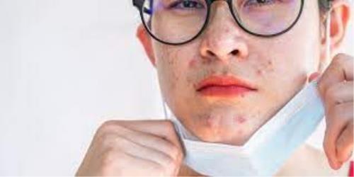 چگونه ماسکنه را درمان کنیم؟