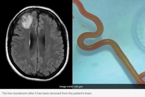 کشف کرم زنده در مغز بیمار استرالیایی