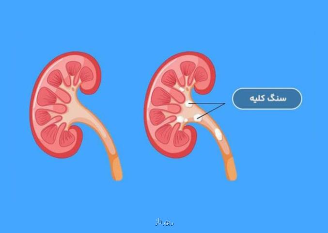 جدیدترین روش های خانگی و دارویی دفع سنگ کلیه