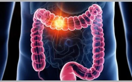 سرطان روده بزرگ بررسی دلایل شیوع بیشتر در جوانان، علایم و نکات پیشگیری