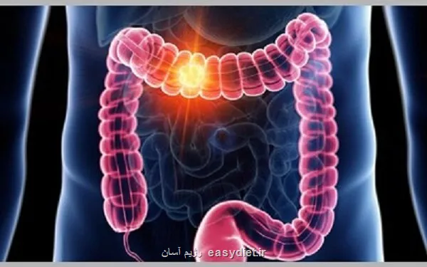 سرطان روده بزرگ بررسی دلایل شیوع بیشتر در جوانان، علایم و نکات پیشگیری