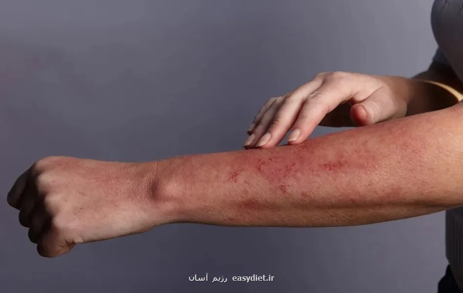 دلیل عود جوش و حساسیت های پوستی در بهار چیست؟
