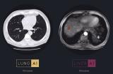 نرم افزار هوش مصنوعی كشف جراحت در كبد و ریه