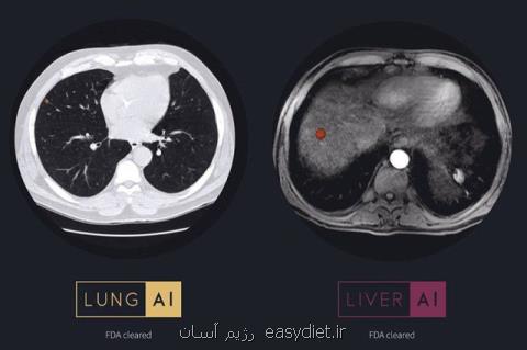 نرم افزار هوش مصنوعی كشف جراحت در كبد و ریه
