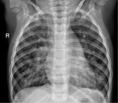 چگونه ویروس كرونا در چند ساعت به سلول های ریه صدمه می زند؟